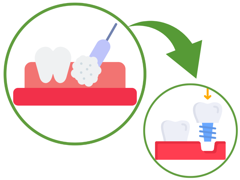 骨造成イメージ