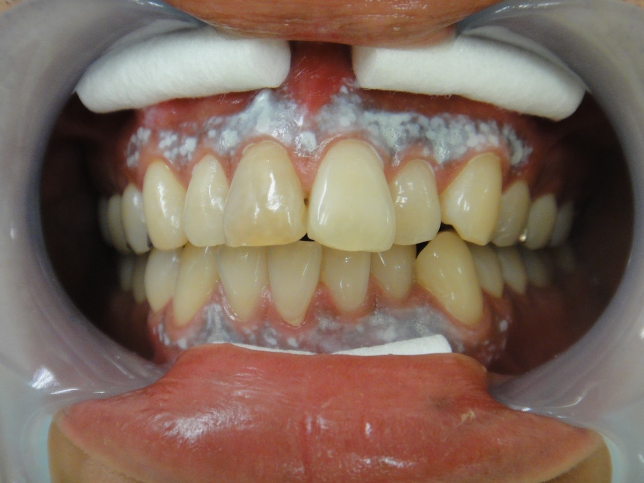 ガムピーリング症例治療経過