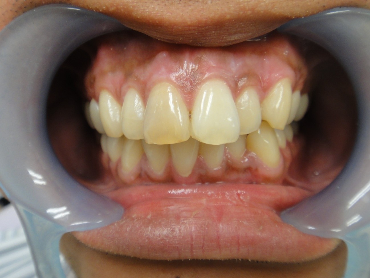 ガムピーリング症例After