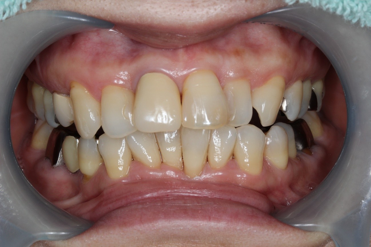 セラミッククラウン+ホワイトニング症例Before