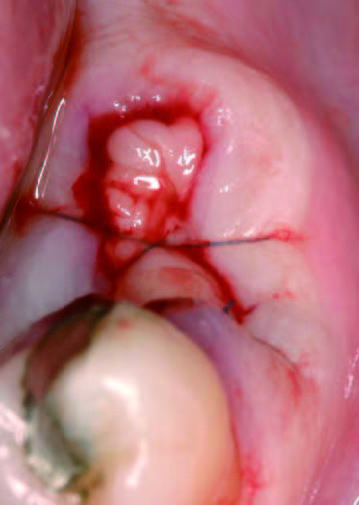 PRGFあり抜歯とEndore填入