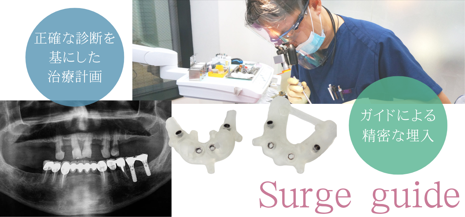 サージガイド画像