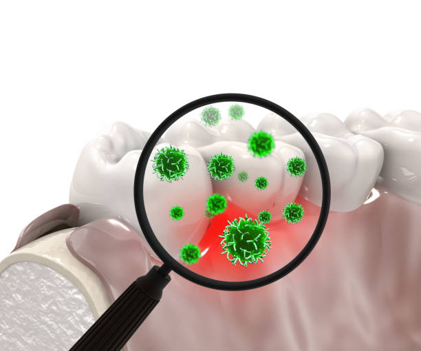 歯周病菌のイメージ